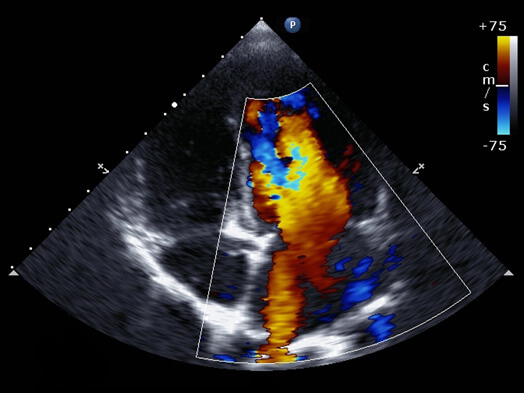 echocardiogram test