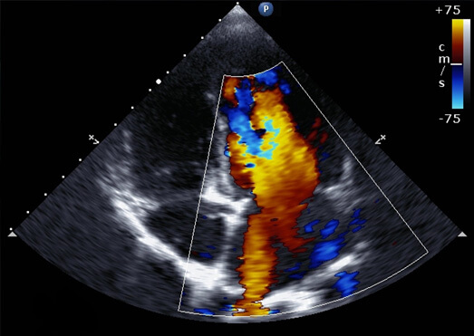 Non-invasive Coronary Angiogram